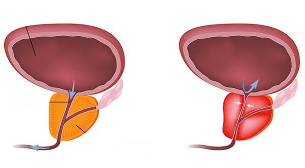 stagnant prostatitis)