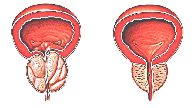 healthy and sick prostate