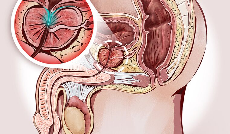 prostatitis and its treatment with folk remedies